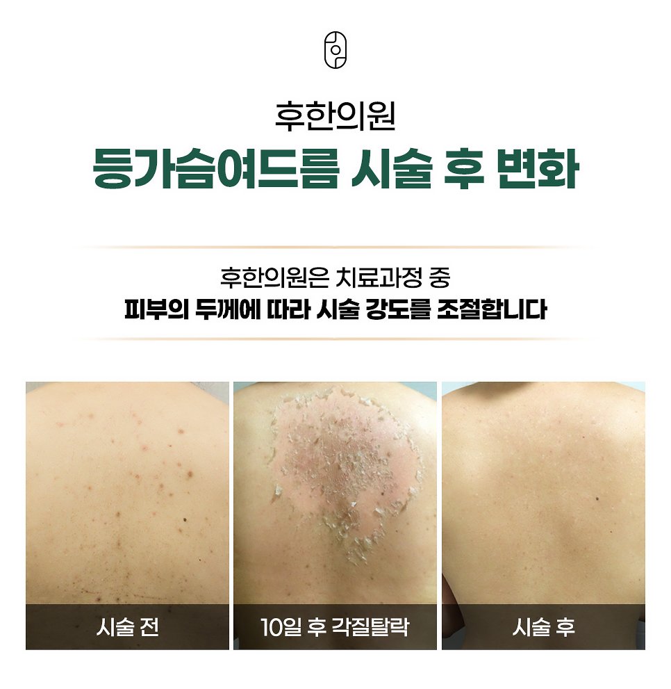 대구등드름 후윤약초필링 변화 