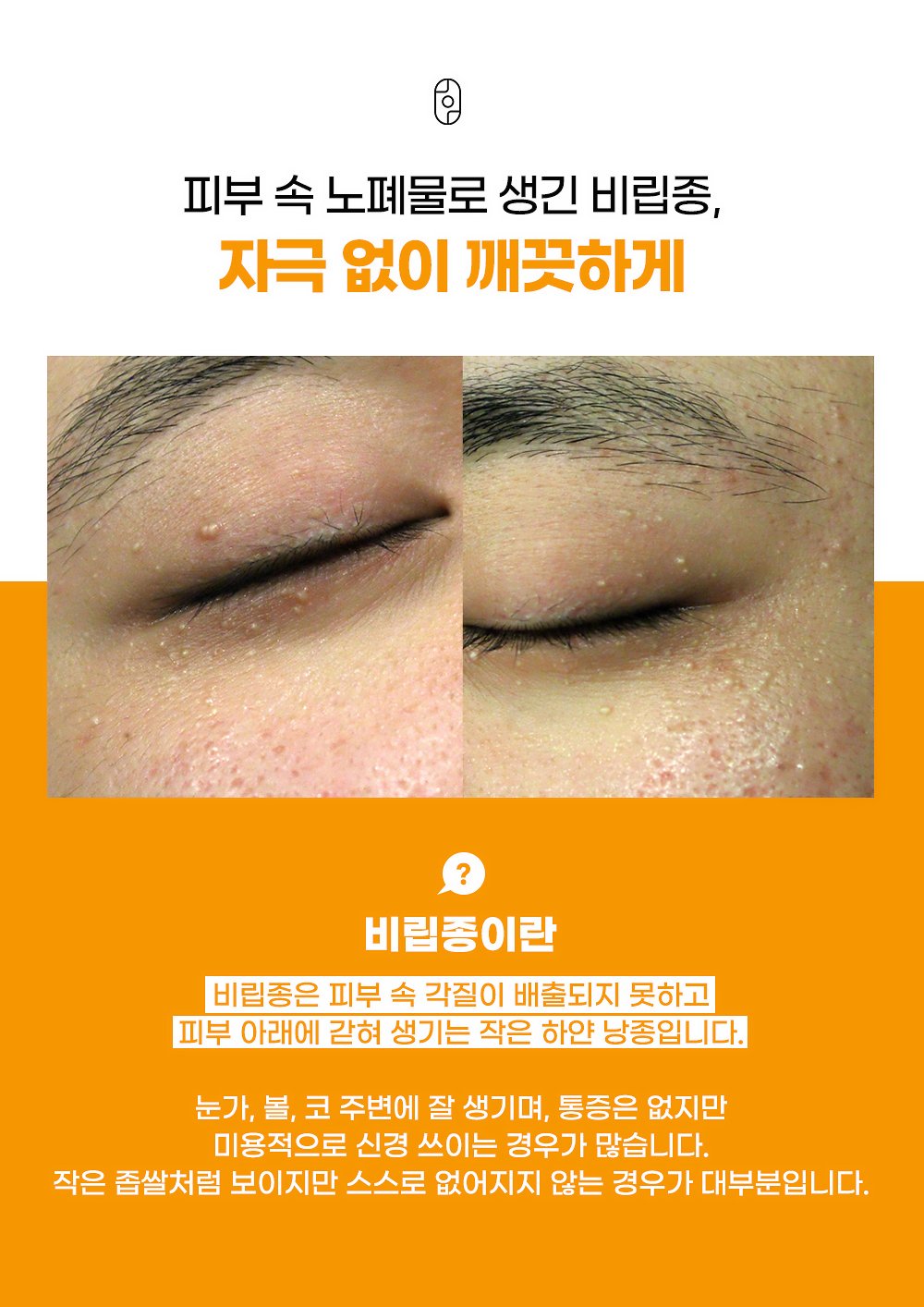 비립종 정의 
