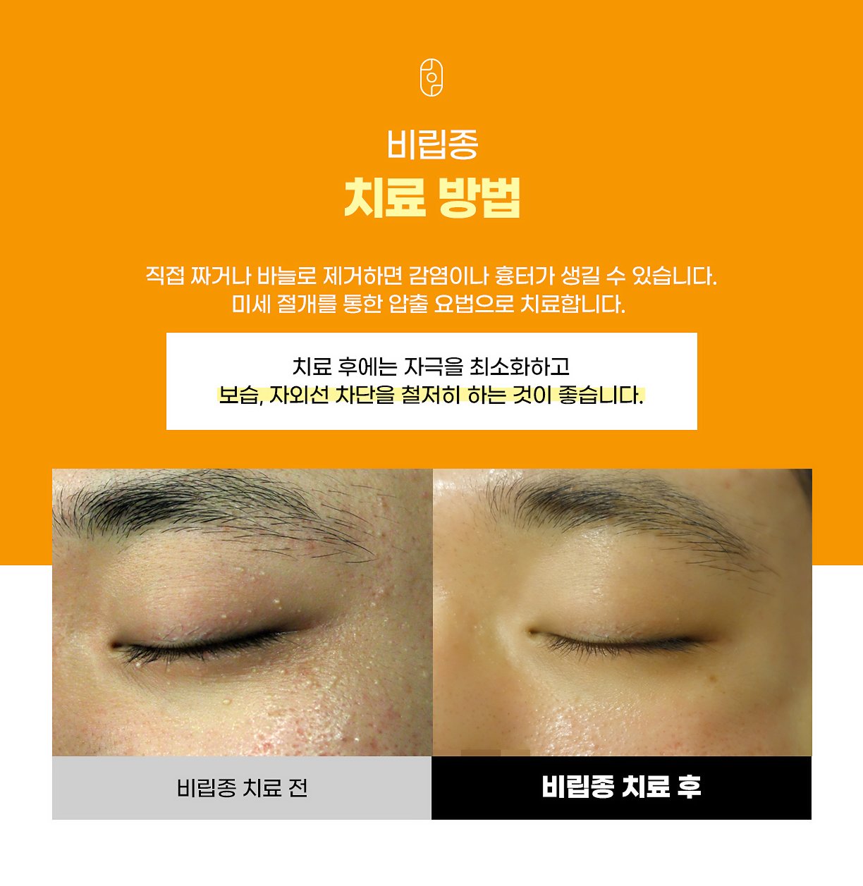 대구 비립종 치료 사율침 시술 치료 전후 