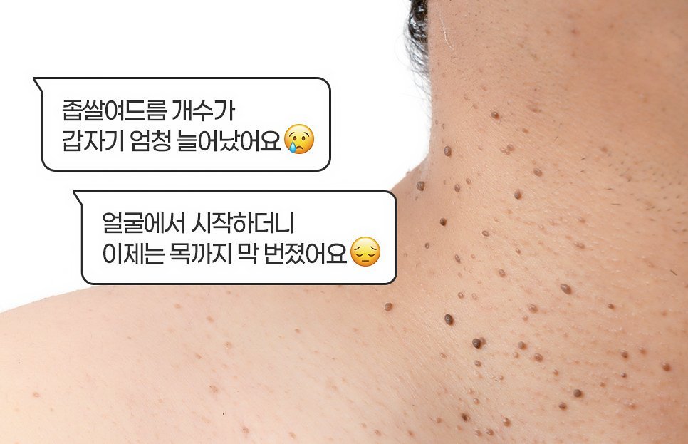 대구편평사마귀 제거 