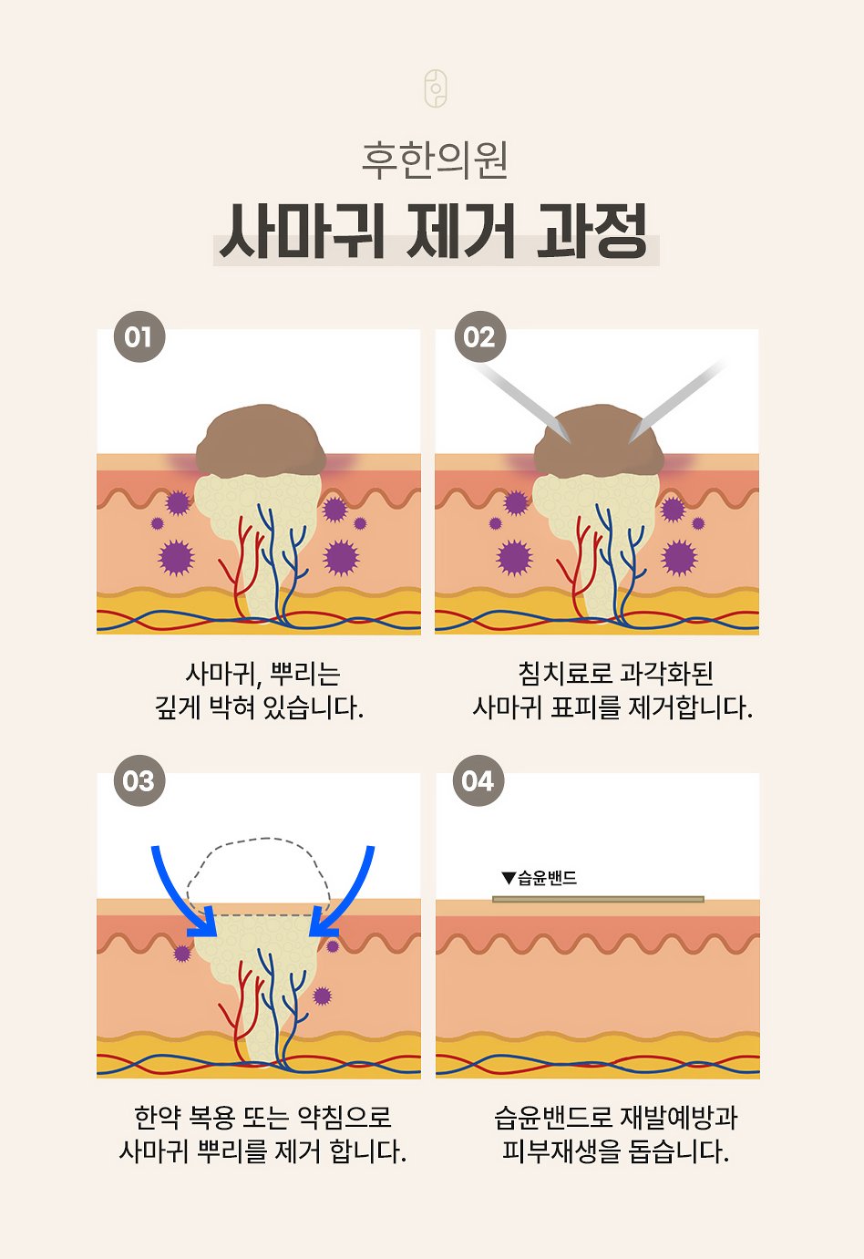 대구 편평사마귀 침제거법