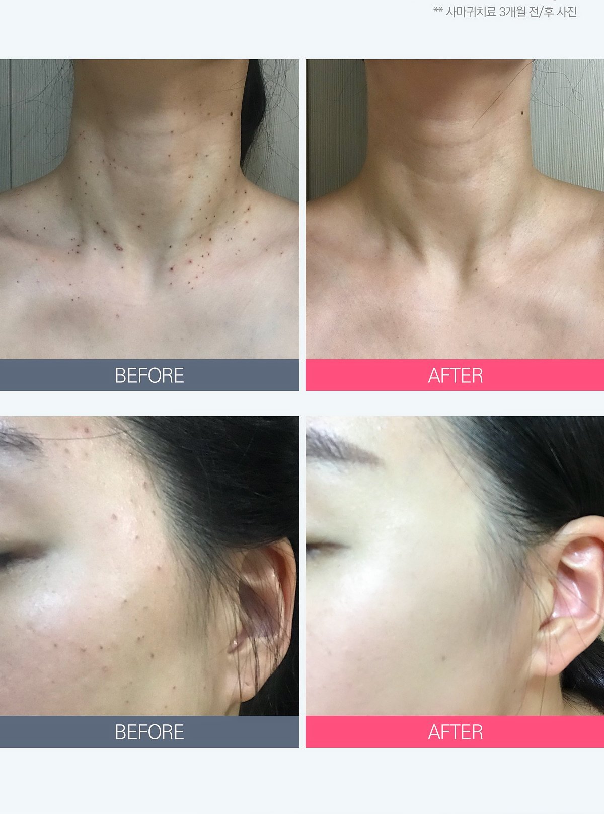 대구편평사마귀치료전후