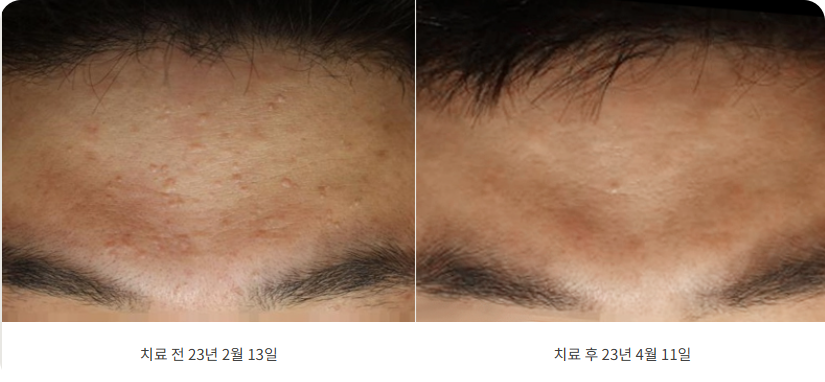 헤어라인 편평사마귀 치료 전후 3개월 재발없이 개선된 사례