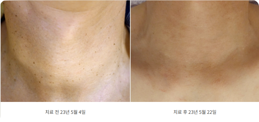 편평사마귀 목 치료 전후 사진 18일만에 매끈해진 피부