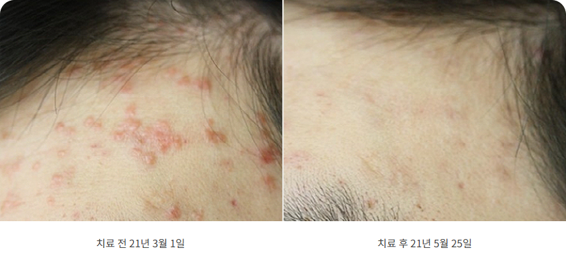 대구편평사마귀제거 이마 촘촘한 돌기 2개월 치료 전후 비교