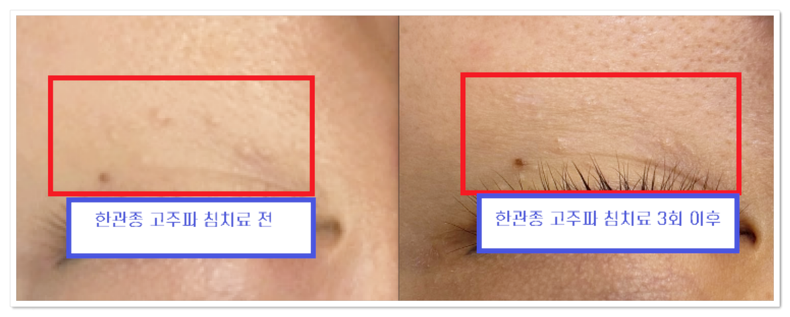 대구눈밑좁쌀치료 한관종 3회 치료 경과 눈가 좌우대칭 돌기 개선 사진
