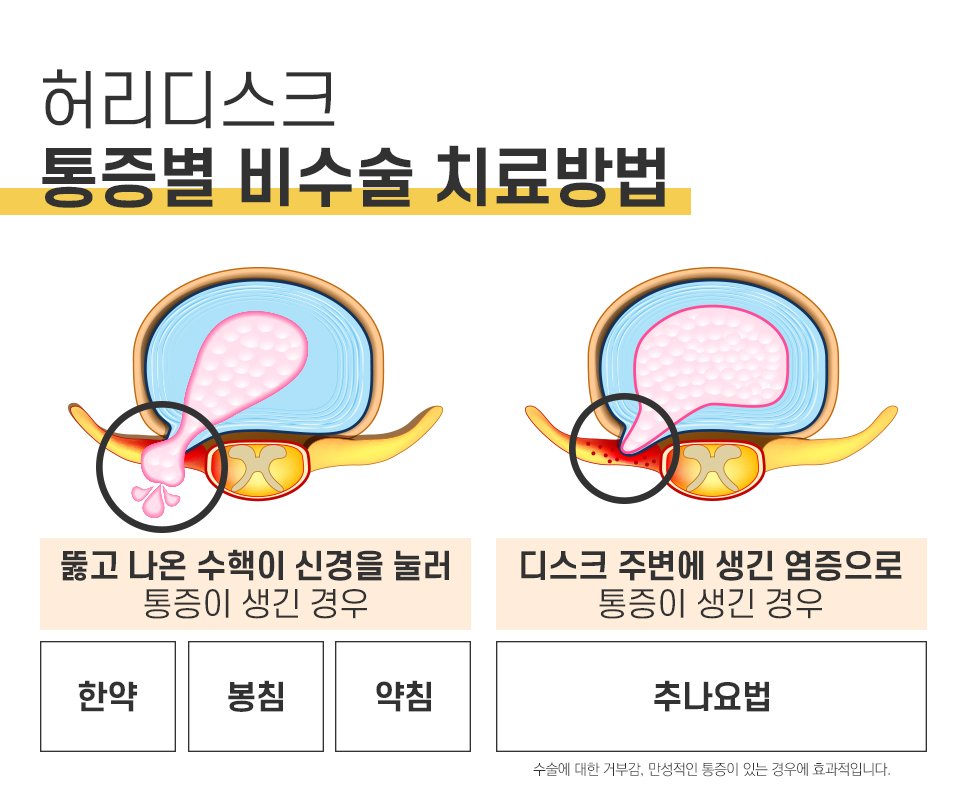 허리디스크 비수술 치료 한약 봉침 약침 추나요법 비교