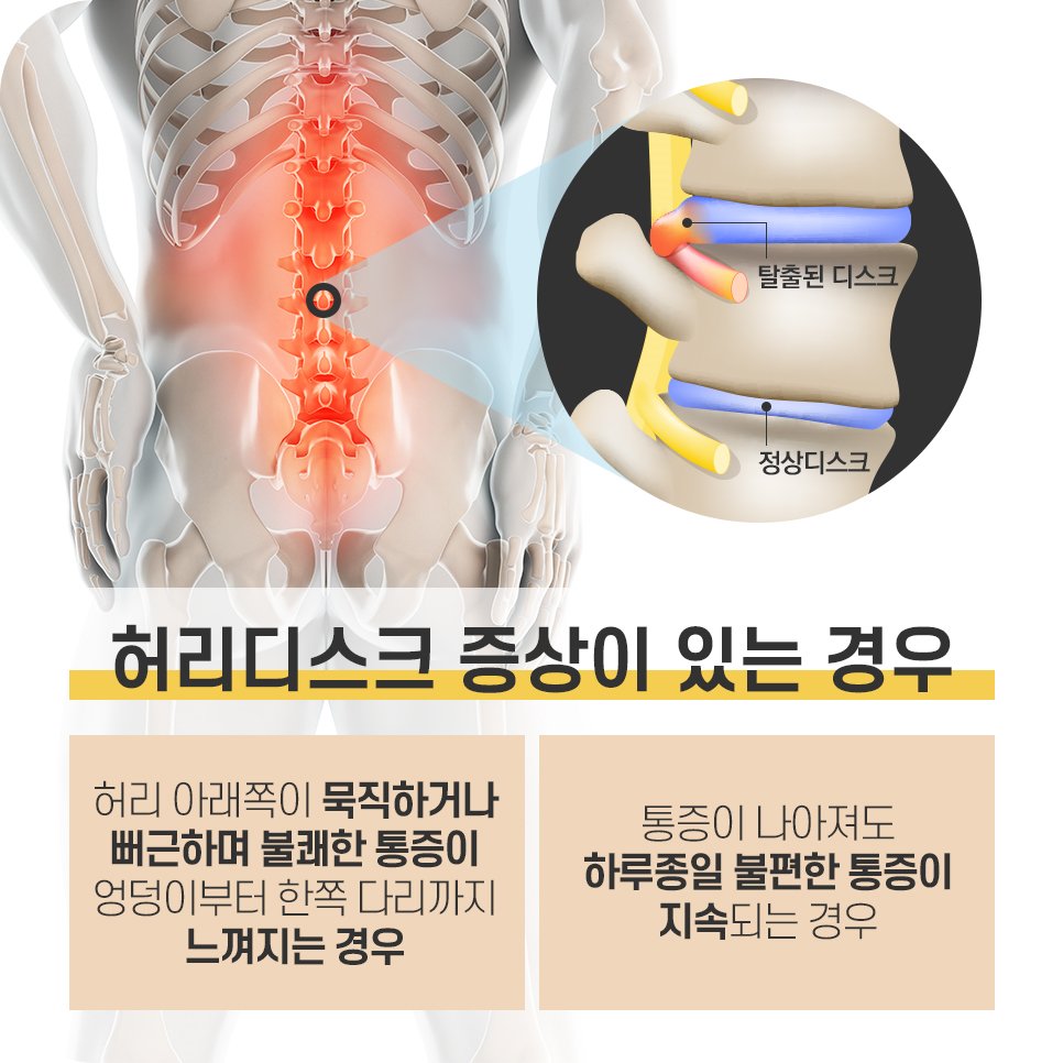 허리디스크 증상 엉덩이 다리 저림 통증 부위 일러스트