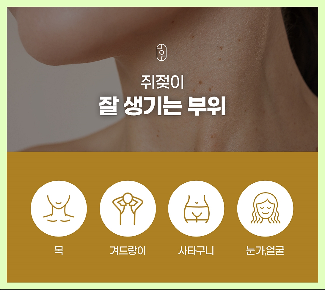 쥐젖이 잘 생기는 부위를 말하는 내용의 이미지