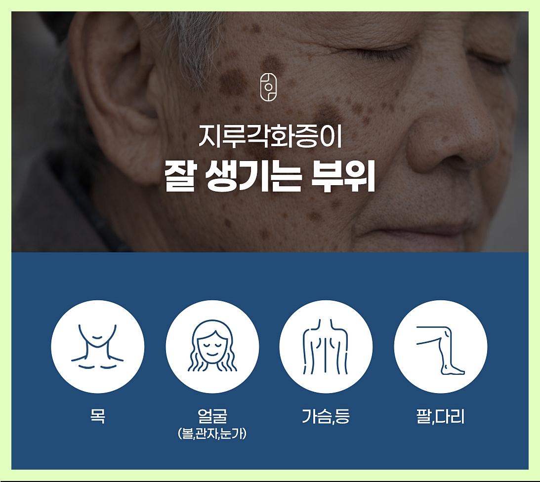 검버섯이 잘 생기는 부위에 대한 이미지