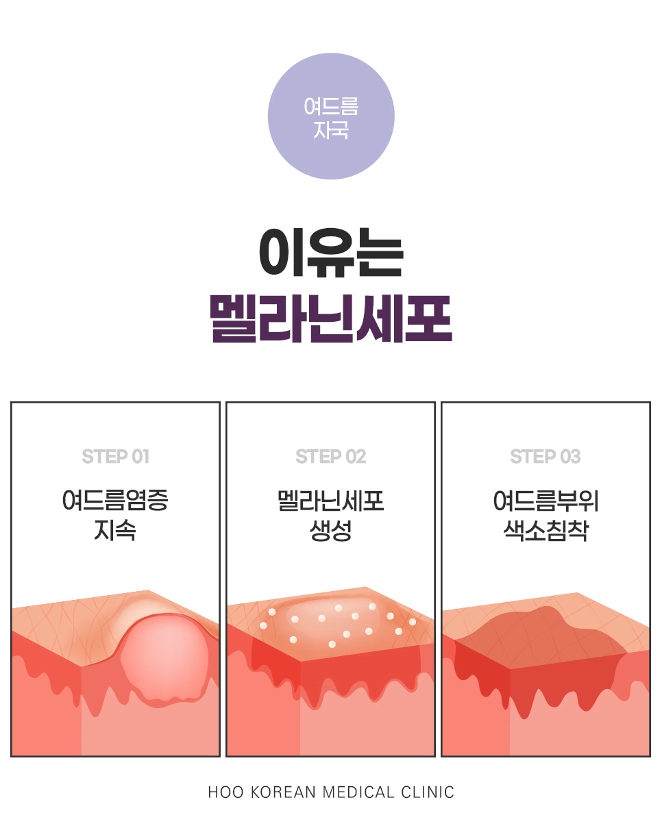 	여드름 자국이 생기는 원인 - 염증 지속, 멜라닌세포 생성, 색소침착 3단계