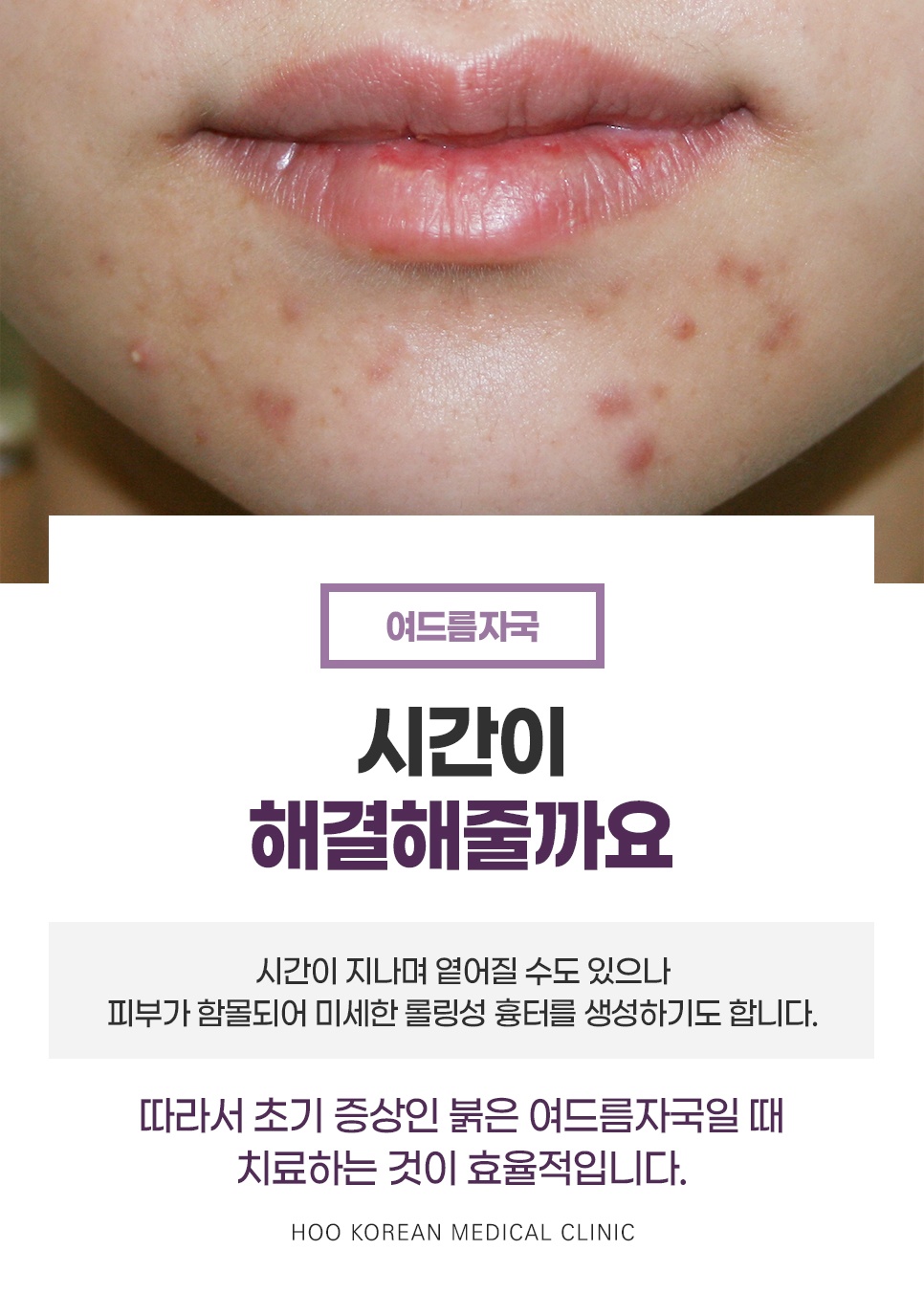 	입 주변 붉은 여드름자국이 남은 피부, 조기 치료 필요성 설명