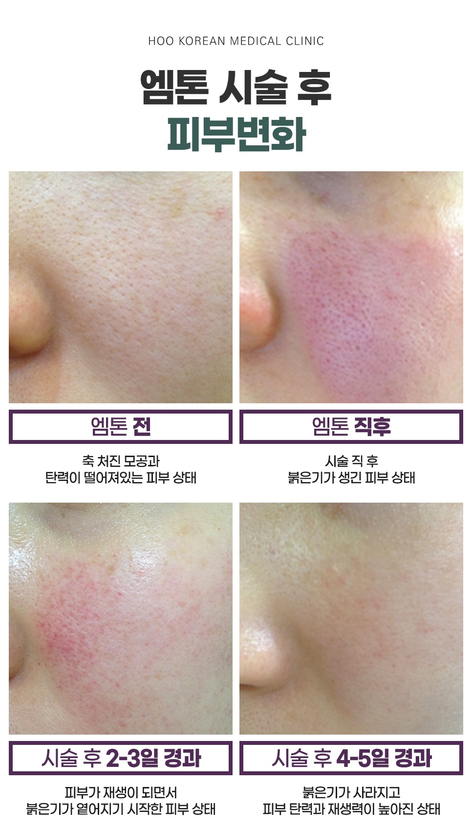 엠톤 시술 전후 및 경과일별 볼 피부 변화 4단계 비교 사진