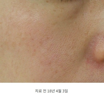 모공 치료 전 볼 피부 클로즈업, 2018년 4월 촬영