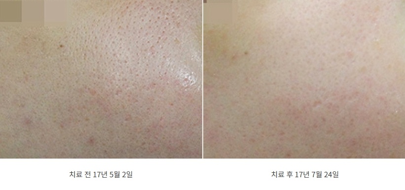 모공 치료 전후 볼 피부 비교, 2017년 5월과 7월 촬영