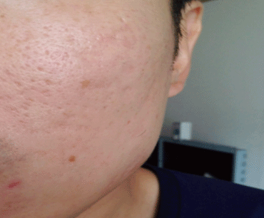 깊게 패인 흉터가 차오른 모습