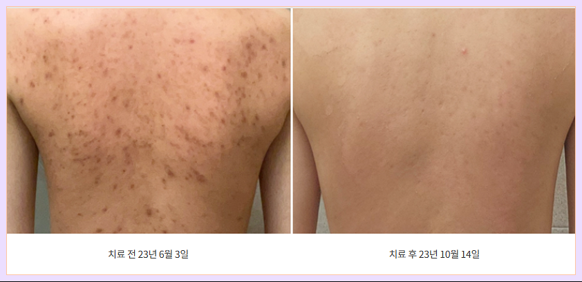 대구등필링 시술 전후 비교 이미지