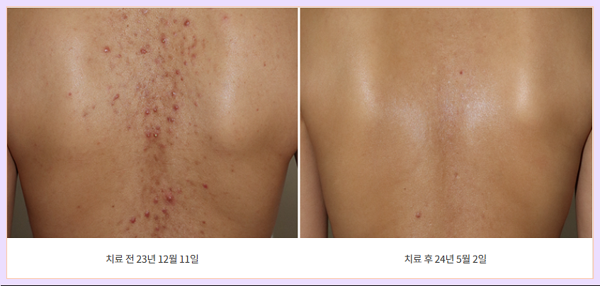 등여드름 치료하기 전과 후를 보는 이미지