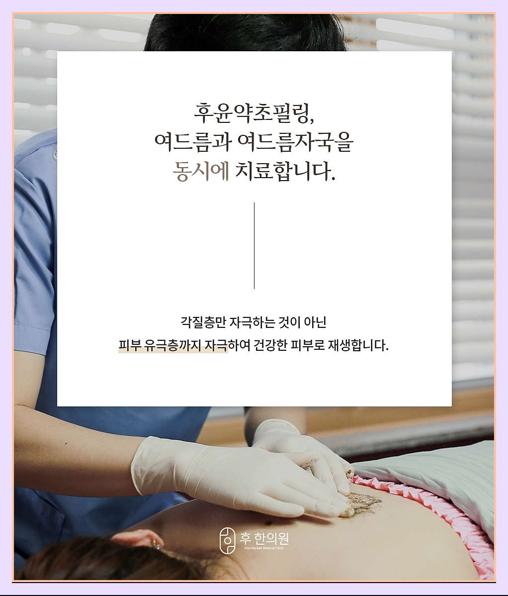 여드름과 자국을 동시에 잡는 약초필링의 특징 이미지