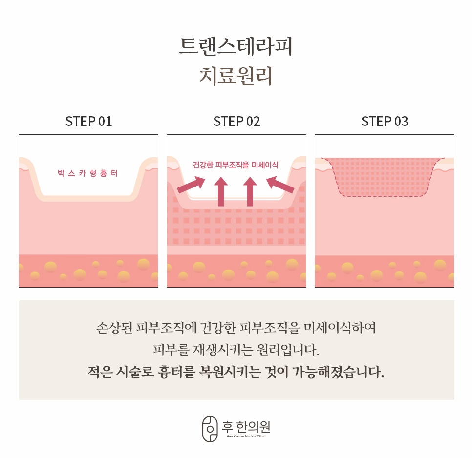 트랜스테라피 치료 원리 - 건강한 피부조직 미세이식 복원 단계별 그래픽