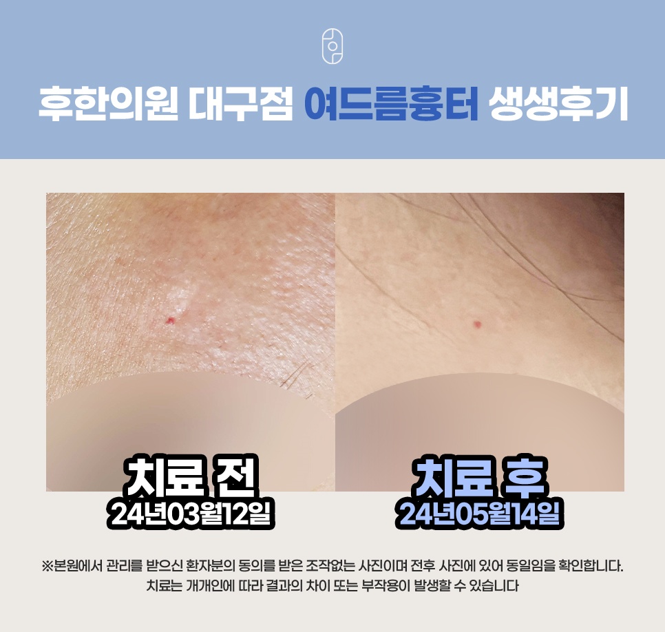 후한의원 대구점 여드름흉터 치료 전후 비교 사진 (2024년 3월 12일~5월 14일)