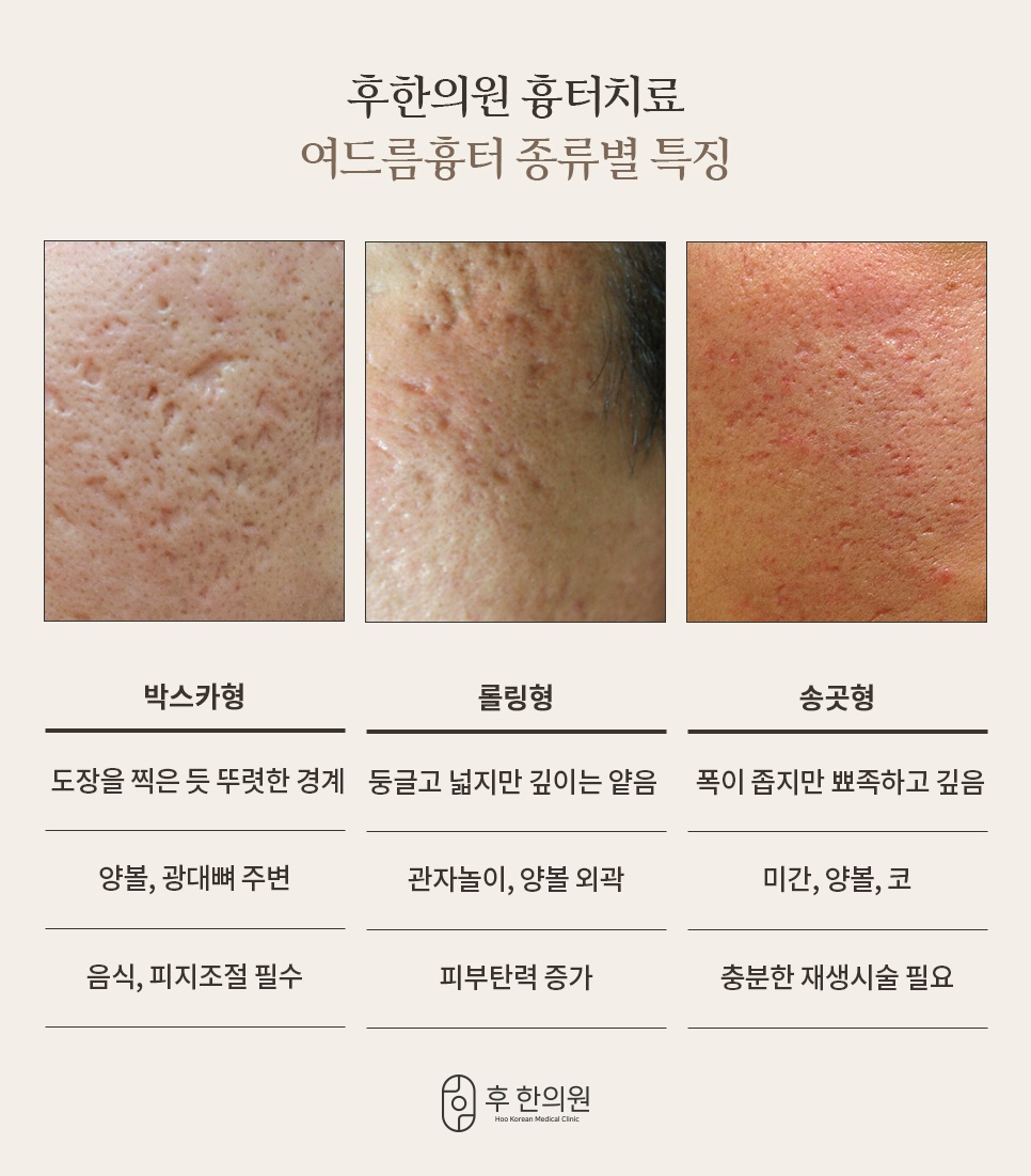 여드름흉터 종류별 특징 - 박스카형, 롤링형, 송곳형 흉터비교 및 치료법