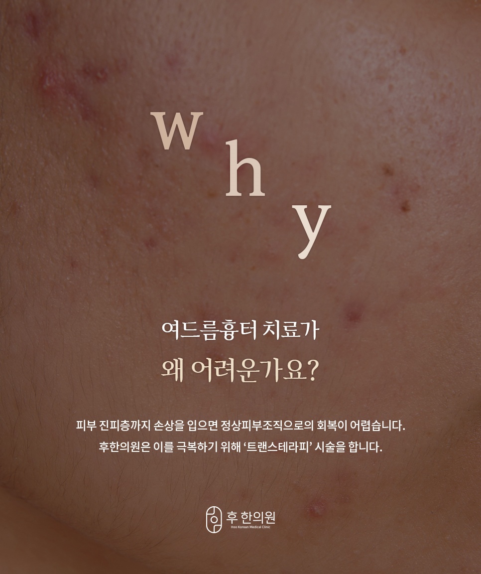 여드름흉터 치료가 어려운 이유 - 후한의원 트랜스테라피 시술 안내