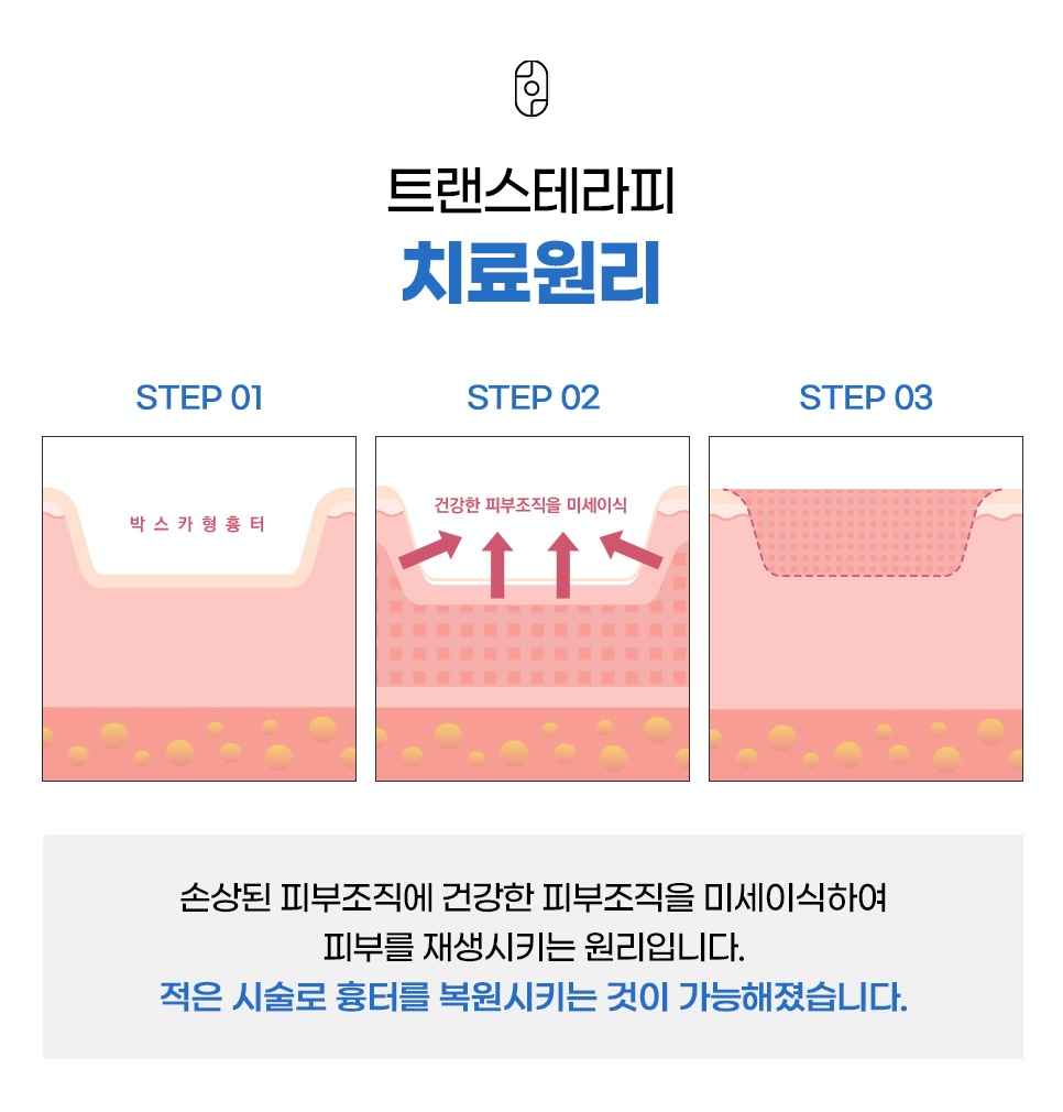 손상된 피부조직에 정상 피부를 미세이식하는 트랜스테라피 치료원리