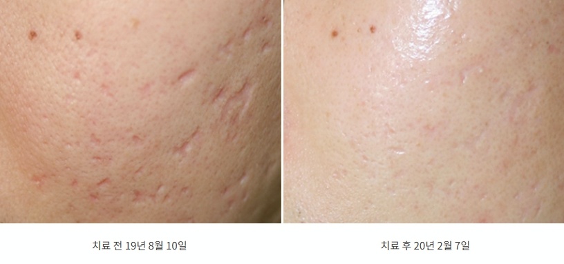 롤링성 및 흉터 피부 개선 전후 비교 사진