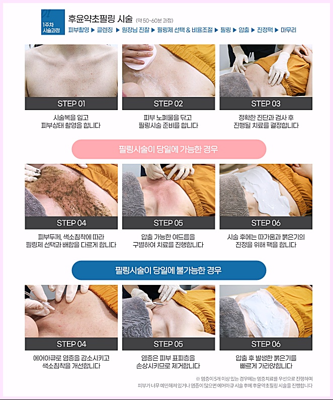 후한의원 후윤약초필링 시술 과정 안내
