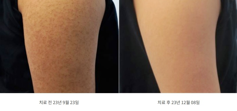 모공각화증 치료 전(23년 9월)과 후(23년 12월)의 팔 피부 상태 비교 사진