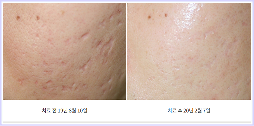여드름흉터 치료 전후