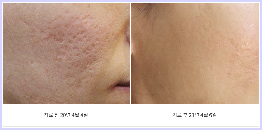 대구여드름흉터 치료 전후 비교 이미지