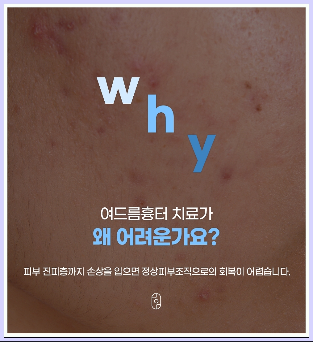 여드름 흉터 치료가 어려운 이유