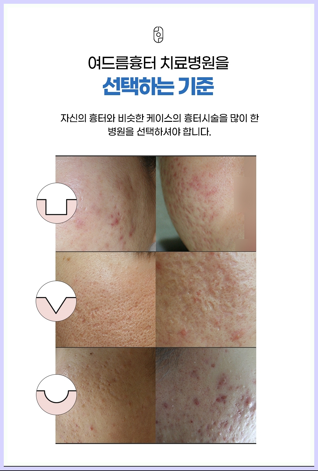 여드름 흉터 다양한 예시 이미지