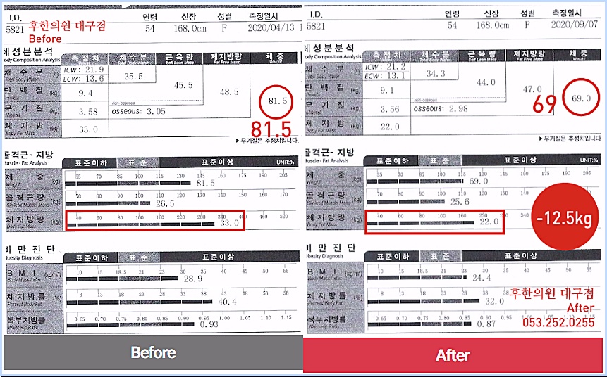 대구다이어트한약 복용 전후 인바디 비교, 체중 81.5kg에서 69.0kg으로 12.5kg 감량