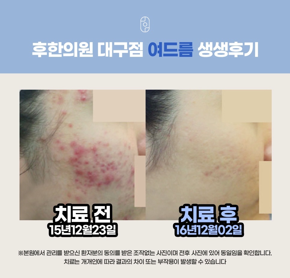 후한의원 대구점 여드름 치료 1년 간격 전후 비교 후기
