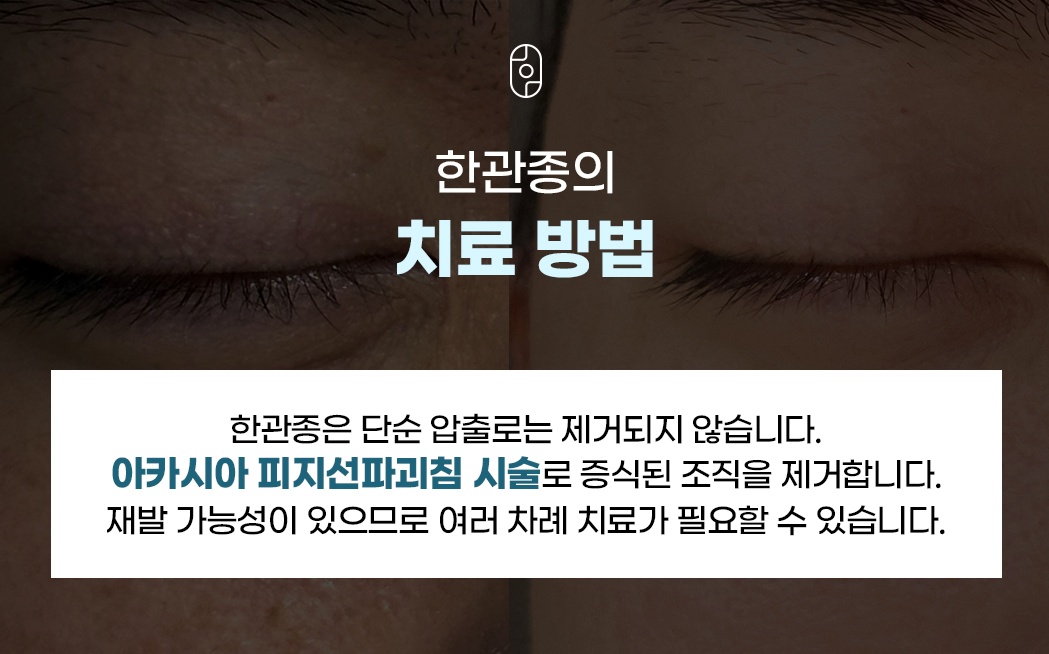 아카시아 피지선파괴침을 이용한 한관종 치료 방법