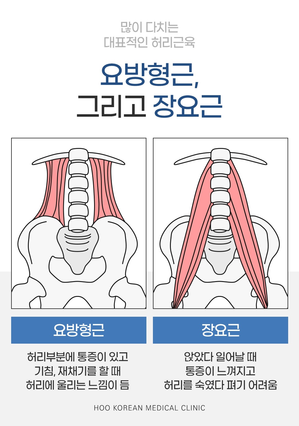 허리 통증 주요 원인 요방형근과 장요근 구조