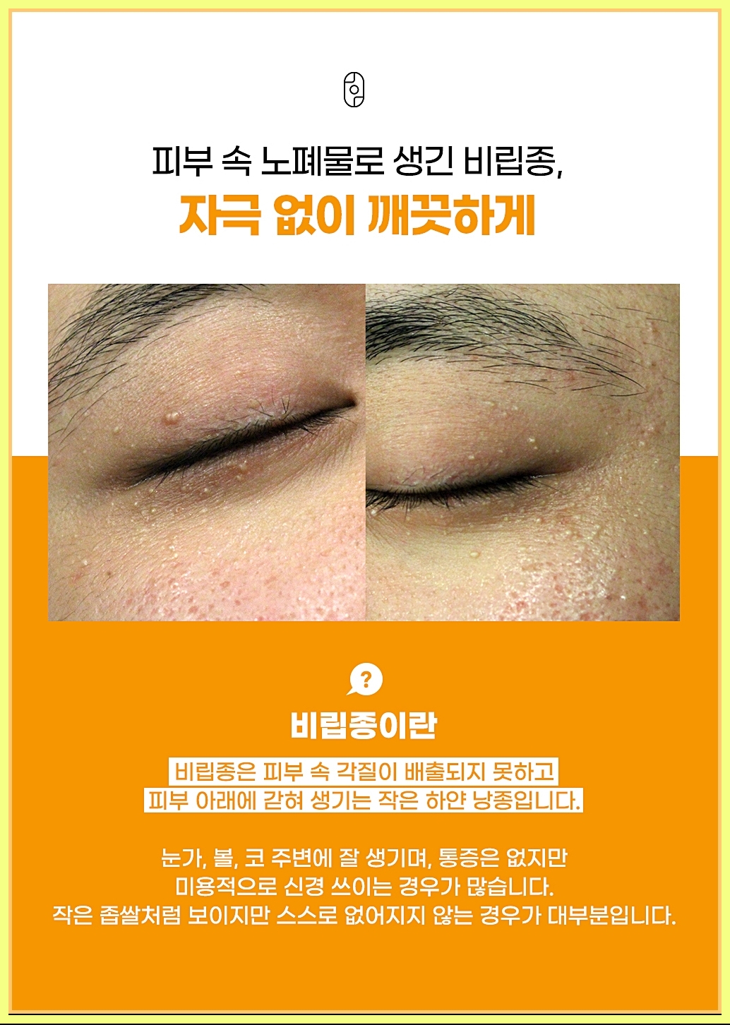 대구비립종 정의