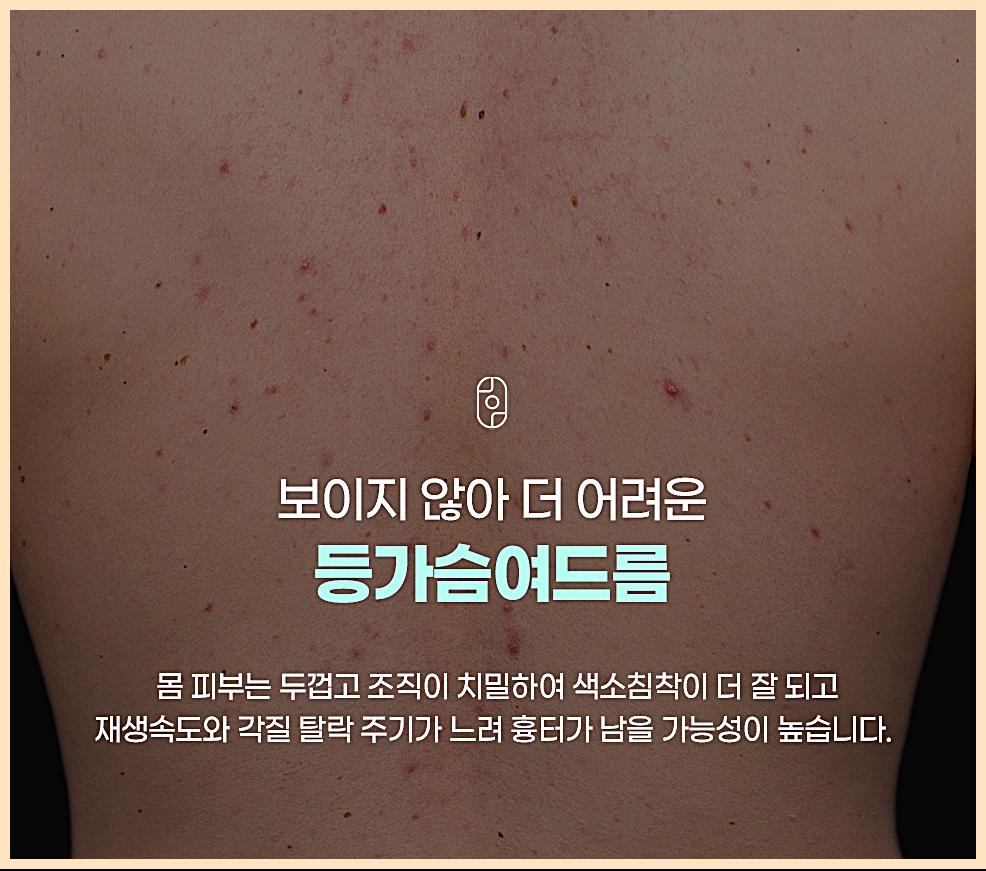 대구등여드름치료 전 확인하는 보이지 않아 더 어려운 등가슴여드름 피부