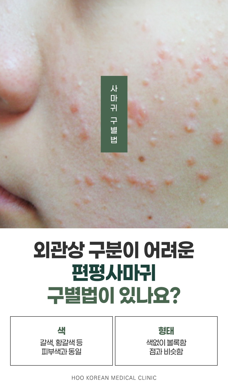 색과 형태로 보는 편평사마귀 구별법과 볼 위 돌기 피부 사진