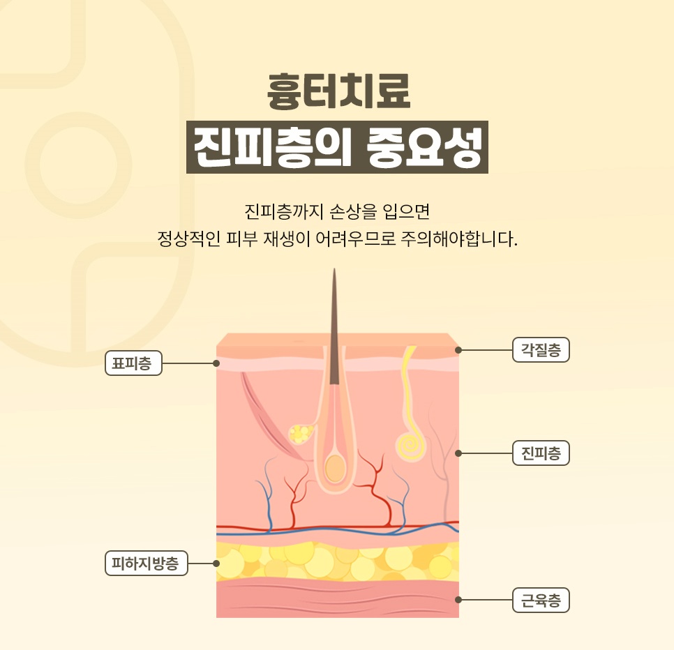 표피부터 근육층까지 피부 구조로 보는 진피층 손상과 흉터 재생의 관계