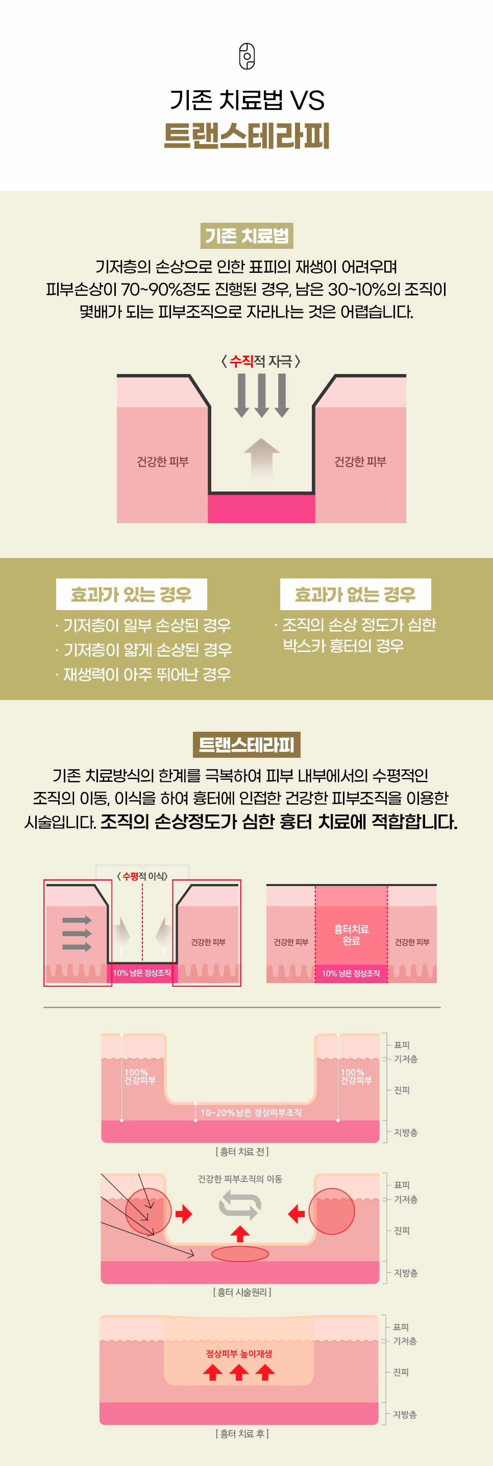 수직 자극 방식과 수평 이식 방식을 비교한 트랜스테라피 시술 원리 도해