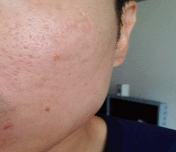 패인 자국이 얕아져 피부 표면이 고르게 보이는 여드름흉터 치료 후 사진