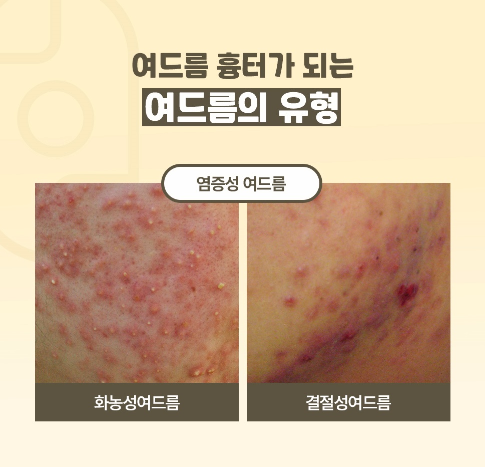 화농성·결절성 여드름으로 나눈 흉터로 이어지는 염증성 여드름 유형