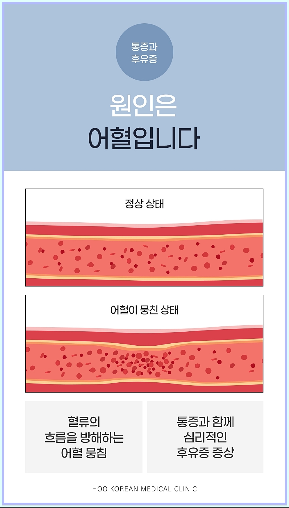 교통사고 통증의 원인 어혈 이미지