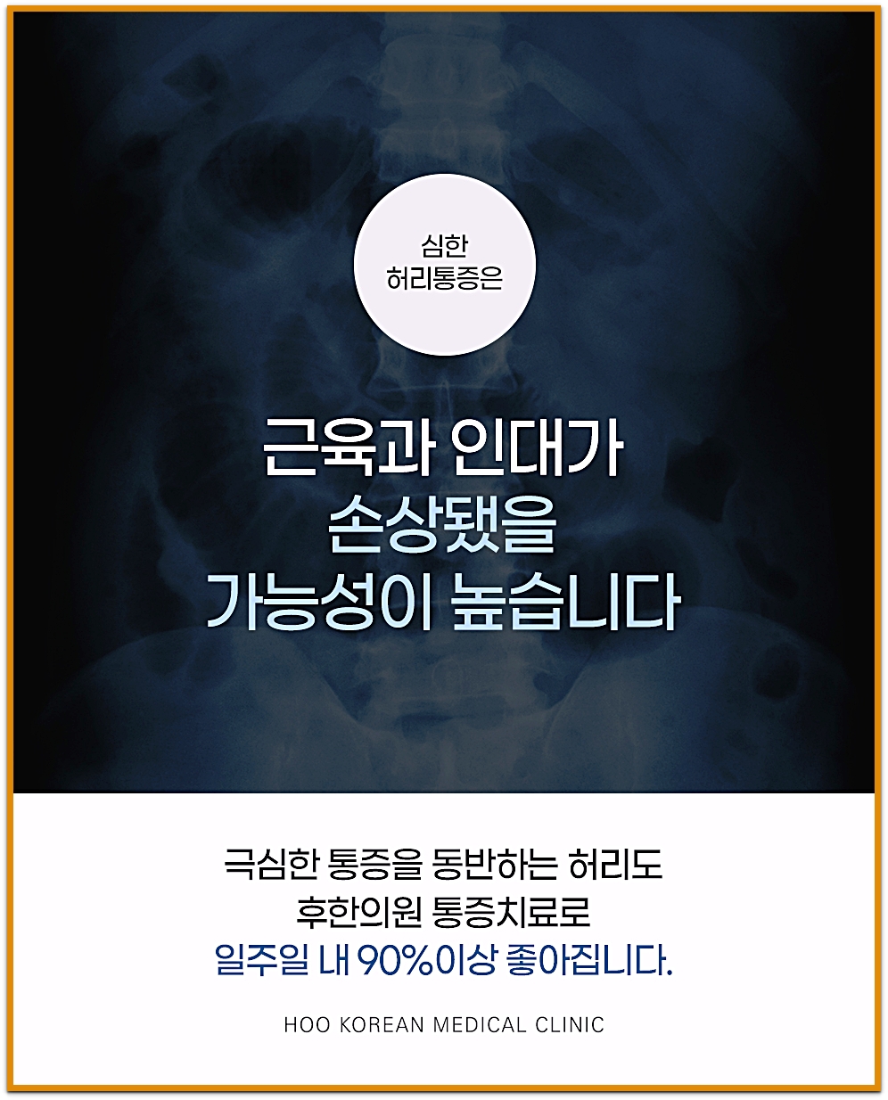 대구한의원추천 심한 허리통증에서 근육과 인대 손상 가능성을 설명하는 허리 X-ray 이미지