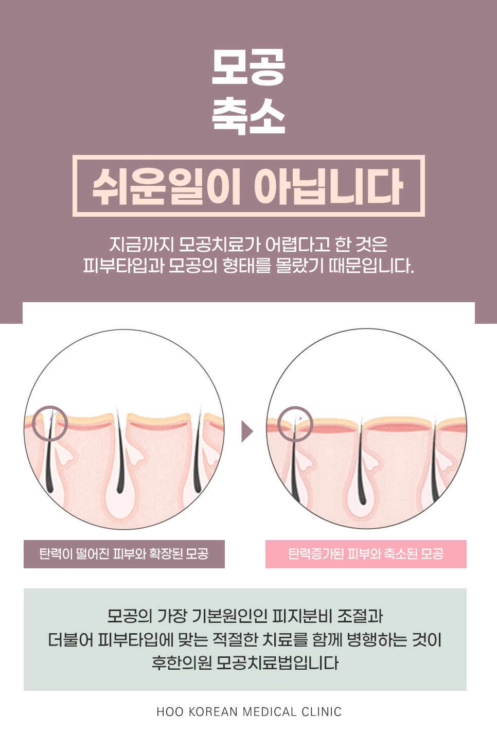 피부타입과 모공 형태에 맞춘 탄력 회복 도해로 보는 모공축소 치료 원리