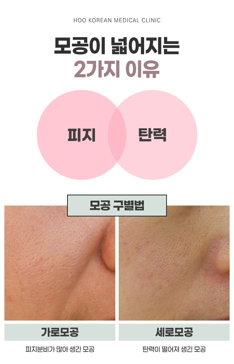 모공이 넓어지는 이유를 피지와 탄력 두 가지로 나누고 가로모공·세로모공을 비교한 구별법